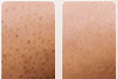 Ingrown Hair Oil | 1 Gallon | 128 fl.oz. before and after skin showing removal of bumps and irritation.